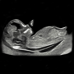 echo-geslachtsbepaling-uniek-geboortezorg